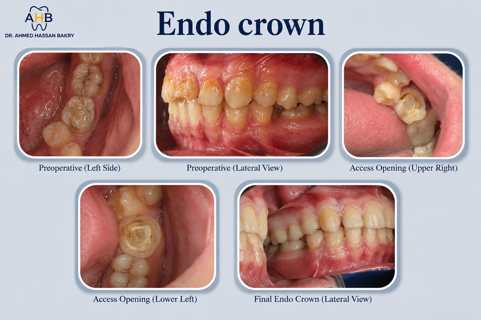 Endo-crown
